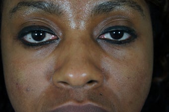 27 year old treated with filler to improve the bags underneath her eyes after 782164