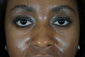27 year old treated with filler to improve the bags underneath her eyes before 782164