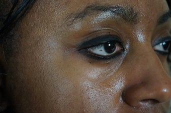 27 year old treated with filler to improve the bags underneath her eyes 782164