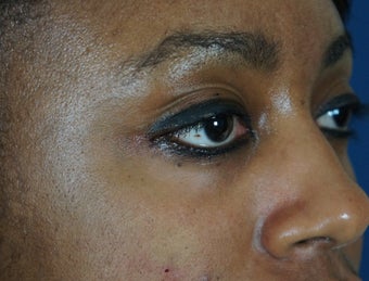 27 year old treated with filler to improve the bags underneath her eyes 782164