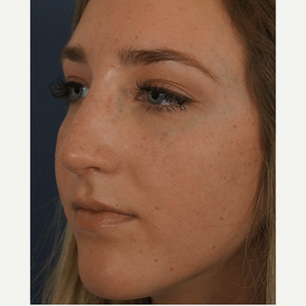18-24 year old woman treated with Rhinoplasty after 3245060