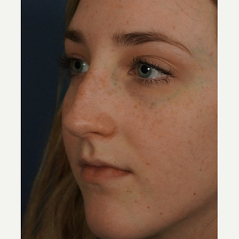 18-24 year old woman treated with Rhinoplasty before 3245060