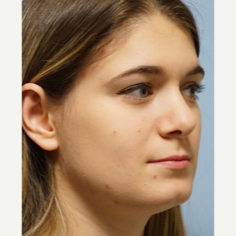 25-34 year old woman treated with Rhinoplasty after 3703418