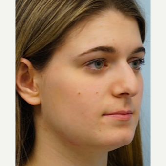 25-34 year old woman treated with Rhinoplasty before 3703418