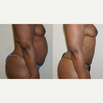 35-44 year old woman treated with Vaser Liposuction before 4583121