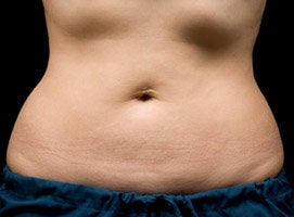 CoolSculpting Procedure with Zeltiq Machine after 218800