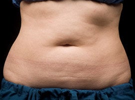 CoolSculpting Procedure with Zeltiq Machine before 218800