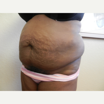 45-54 year old woman treated with Tummy Tuck before 3412813