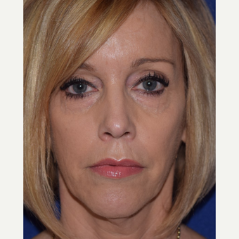 45-54 year old woman treated with Bellafill (ArteFill) after 2873641