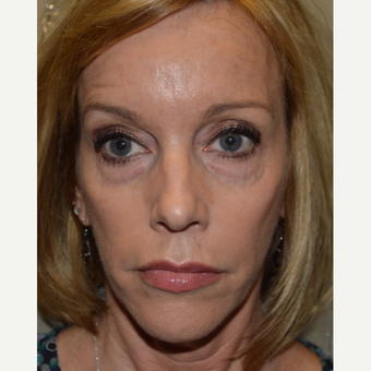 45-54 year old woman treated with Bellafill (ArteFill) before 2873641
