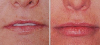 Beforenhancement with Juvederm Dermal Filler before 1094120