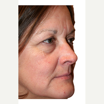 59 year old woman treated with Eye Bags Treatment before 2869849