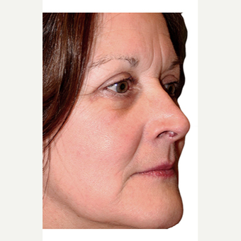 59 year old woman treated with Eye Bags Treatment after 2869849
