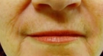 65-74 year old woman treated with CO2 Laser after 2571669