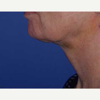 55-64 year old woman treated with laser-assisted Neck Lift after 3638982
