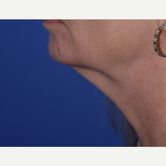 55-64 year old woman treated with laser-assisted Neck Lift before 3638982