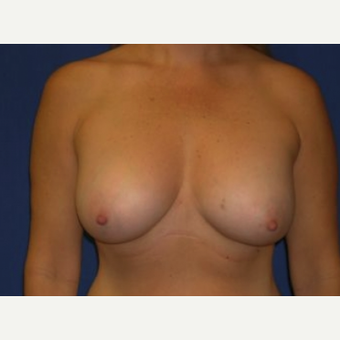 35-44 year old woman treated with Breast Augmentation after 3220144