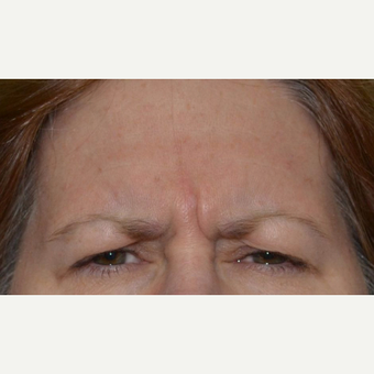 55-64 year old woman treated with Botox before 3520277