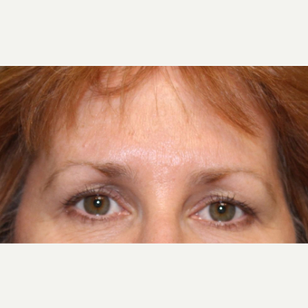 55-64 year old woman treated with Botox after 3520277