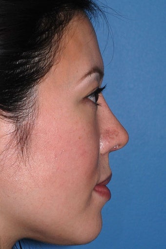 Asian Rhinoplasty after 81094