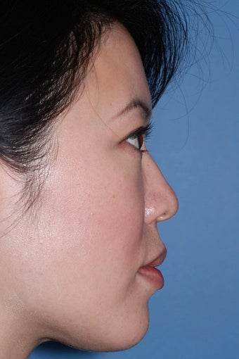 Asian Rhinoplasty before 81094