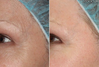 65-74 year old woman treated with Skin Rejuvenation before 2103293
