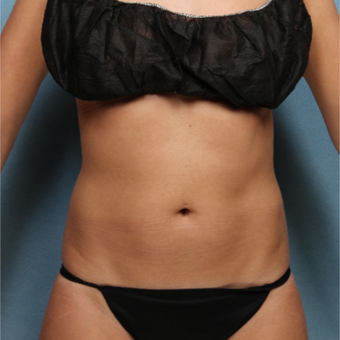 35-44 year old woman treated with CoolSculpting after 3224471