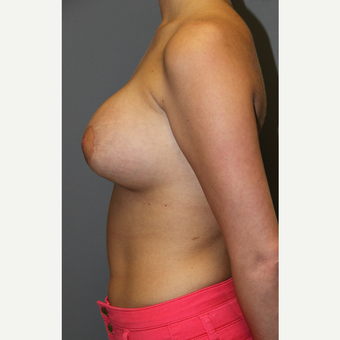 18-24 year old woman treated with Breast Augmentation after 3129143