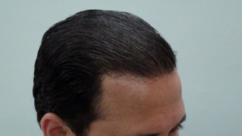 25-34 year old man treated with Hair Transplant 1688125