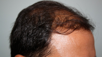 25-34 year old man treated with Hair Transplant 1688125
