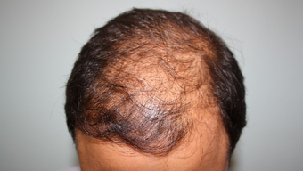 25-34 year old man treated with Hair Transplant before 1688125