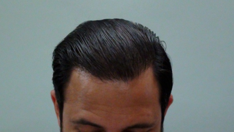 25-34 year old man treated with Hair Transplant after 1688125