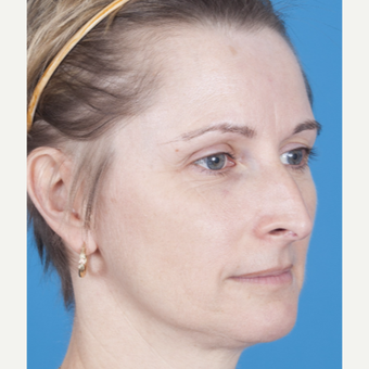 45-54 year old woman treated with Rhinoplasty before 3159564
