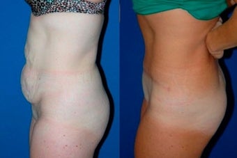 Tummy Tuck before 3037903