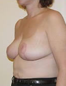 Breast Reduction 1029953