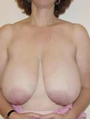 Breast Reduction before 1029953