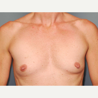 38 y/o Inframammary Sub Muscular Breast Augmentation before 3066094