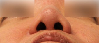 Revision Asian Rhinoplasty 944171