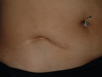 Scar revision of appendectomy scar before 335023
