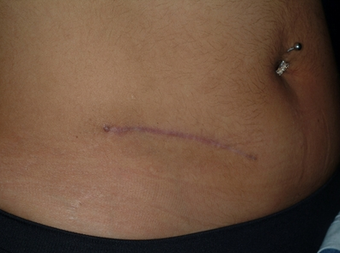 Scar revision of appendectomy scar after 335023
