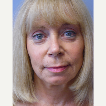 55-64 year old woman treated with Facelift after 3538838