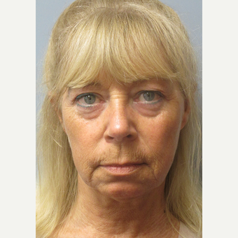 55-64 year old woman treated with Facelift before 3538838