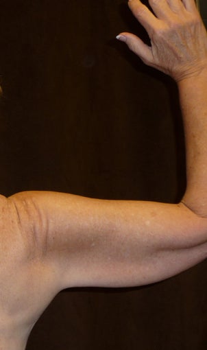 54 Year Old Female Treated for Sagging Arms 986148