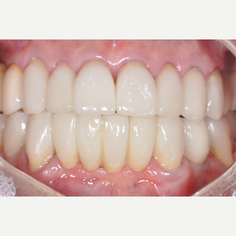Before and After All Porcelan Crowns after 3161939