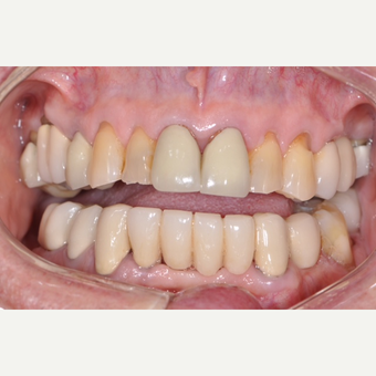 Before and After All Porcelan Crowns before 3161939