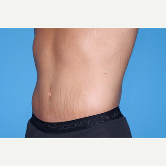 25-34 year old man treated with Body Lift after 3280626