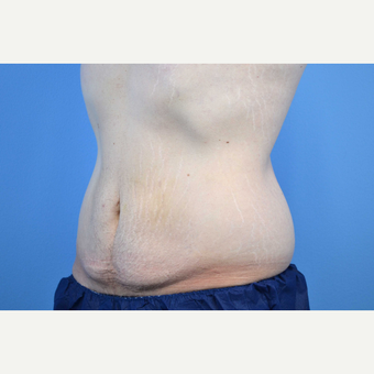 25-34 year old man treated with Body Lift before 3280626