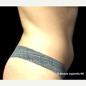 Kybella Fat Reduction in Lower Abdomen before 3264437