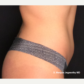 Kybella Fat Reduction in Lower Abdomen after 3264437