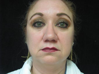 Face, 56 Year Old Female before 1117318